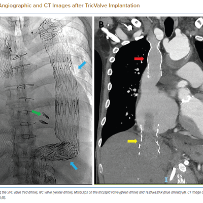 Final Angiographic and CT Images after TricValve Implantation
