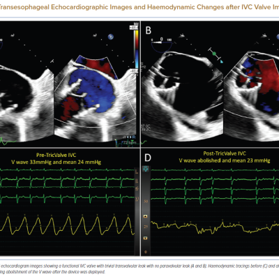 Transesophageal Echocardiographic Images and Haemodynamic Changes after IVC Valve Implantation