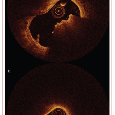 Optical Coherence Tomography of Calcified Nodules