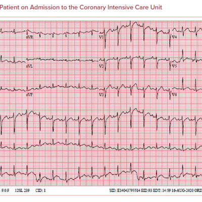 ECG of the Patient on Admission to the Coronary Intensive Care Unit