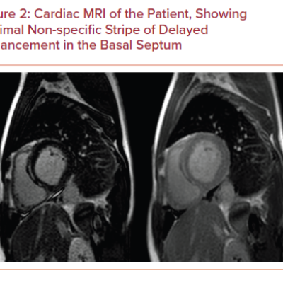Cardiac MRI of the Patient Showing Minimal Non-specific Stripe of Delayed Enhancement in the Basal Septum