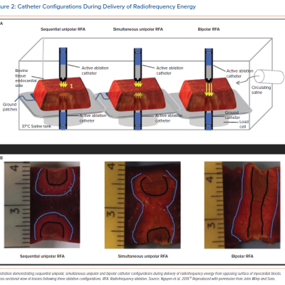Catheter Configurations During Delivery of Radiofrequency Energy