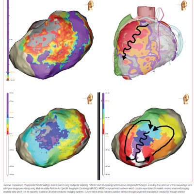 Epicardial High Density Bipolar Voltage Maps versus Integrated CT Images after Post-Image Processing to Guide Ablation