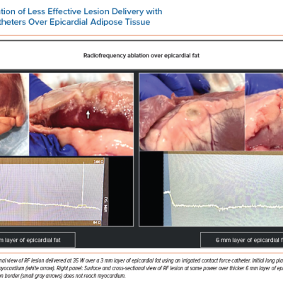 Demonstration of Less Effective Lesion Delivery with Conventional RF Catheters Over Epicardial Adipose Tissue