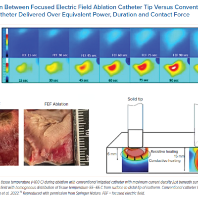 Comparison Between Focused Electric Field Ablation Catheter Tip Versus Conventional Irrigated Ablation Catheter Delivered Over Equivalent Power Duration and Contact Force