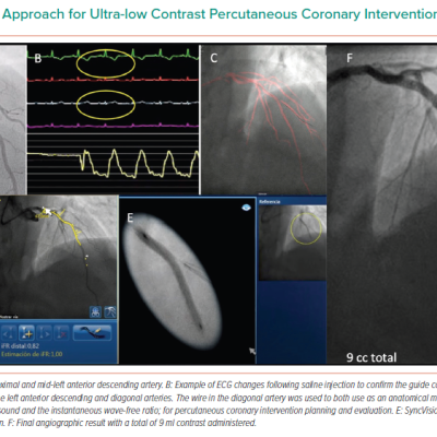 Step-by-step Approach for Ultra-low Contrast Percutaneous Coronary Intervention