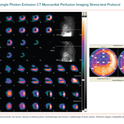 Gated-single Photon Emission CT Myocardial Perfusion Imaging Stress-test Protocol