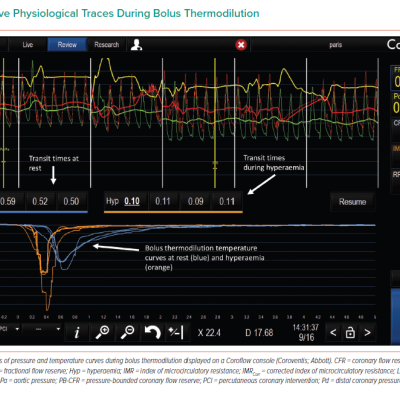 Invasive Physiological Traces During Bolus Thermodilution
