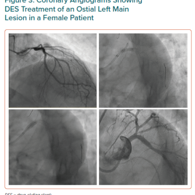 Coronary Angiograms Showing DES Treatment of an Ostial Left Main Lesion in a Female Patient