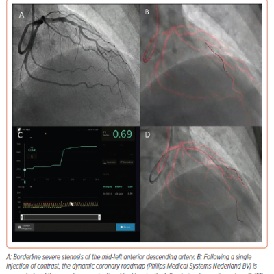 Dynamic Coronary Roadmap Navigational Tool for Vessel Wiring and Stent Placement
