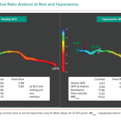 Quantitative Flow Ratio Analysis at Rest and Hyperaemia