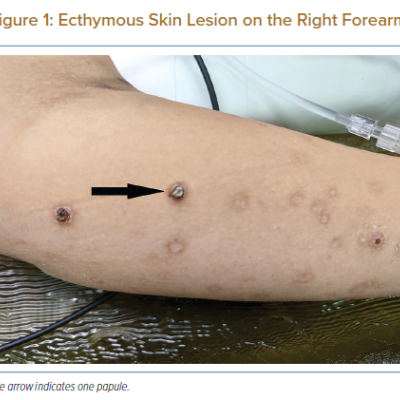 Ecthymous Skin Lesion on the Right Forearm