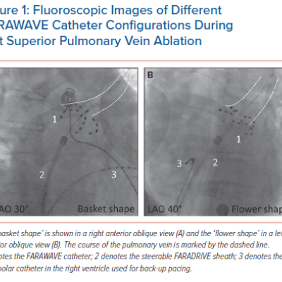 Fluoroscopic Images of Different FARAWAVE Catheter Configurations During Left Superior Pulmonary Vein Ablation