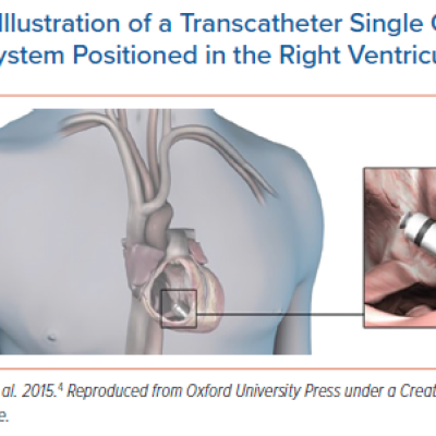 Illustration of a Transcatheter Single Chamber Pacing System Positioned in the Right Ventricular Apex