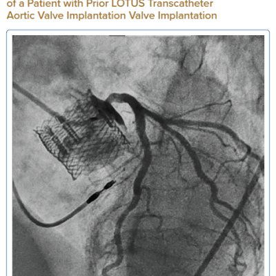 Non-selective Coronary Angiogram of a Patient with Prior LOTUS Transcatheter Aortic Valve Implantation Valve Implantation