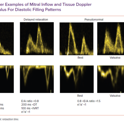 Spectral Doppler Examples of Mitral Inflow and Tissue Doppler Examples of Mitral Annulus For Diastolic Filling Patterns
