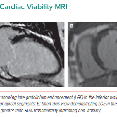 Cardiac Viability MRI