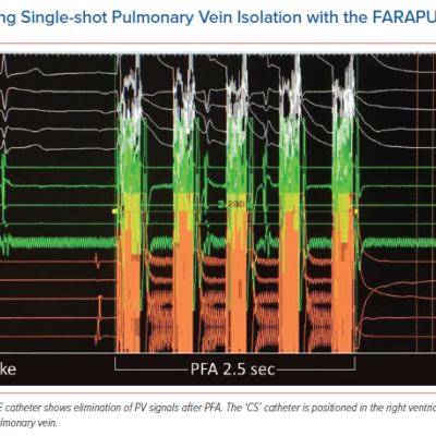 Electrograms During Single-shot Pulmonary Vein Isolation with the FARAPULSE System
