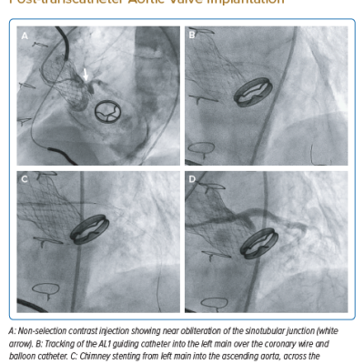 Left Main Artery to Aorta Stenting Post-transcatheter Aortic Valve Implantation