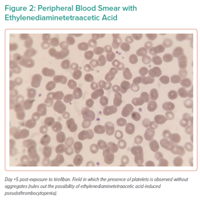 Peripheral Blood Smear with Ethylenediaminetetraacetic Acid