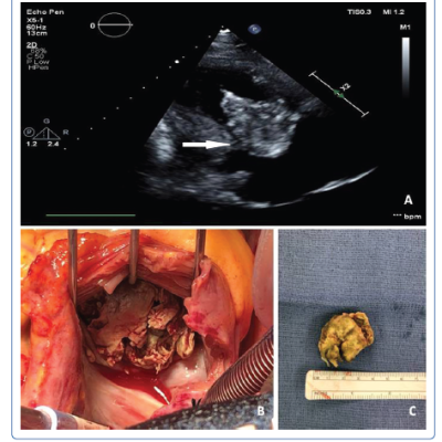 Streptococcus mitis Tricuspid Valve Infective Endocarditis