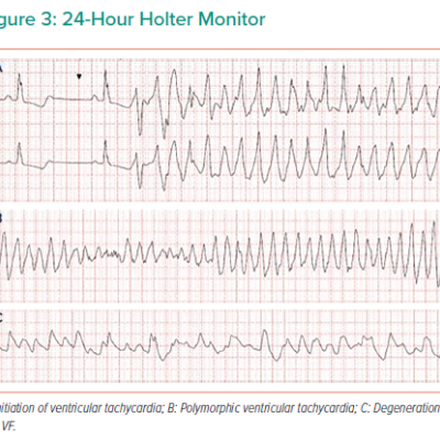 24-Hour Holter Monitor