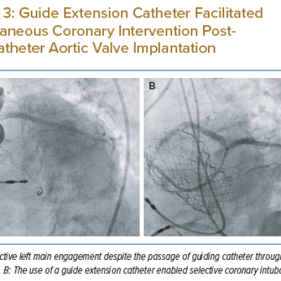 Guide Extension Catheter Facilitated Percutaneous Coronary Intervention Posttranscatheter Aortic Valve Implantation