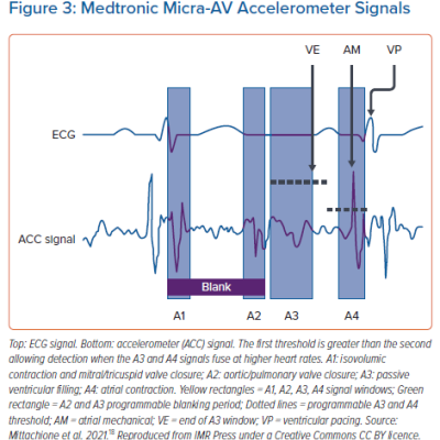 Medtronic Micra-AV Accelerometer Signals