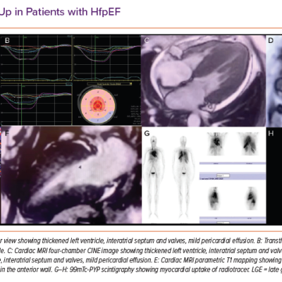Diagnostic Work-Up in Patients with HfpEF
