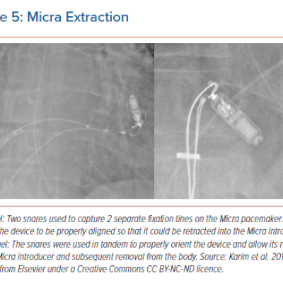 Micra Extraction