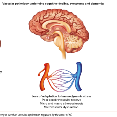 Proposed Mechanisms of Cerebral Vascular Dysfunction Due to Atrial Fibrillation