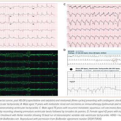 Figure 3 Clinical Examples of Ventricular Arrhythmias in Cancer Patients