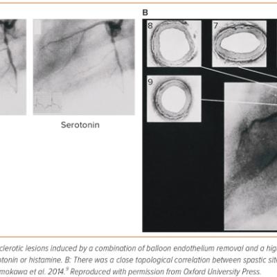 Figure 1 Coronary Artery Spasm in a Porcine Model with Coronary Atherosclerotic Lesions