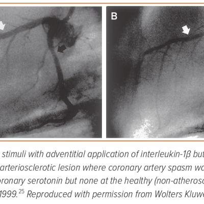 Figure 2 Coronary Artery Spasm in a Porcine Model with Chronic Adventitial Inflammation but without Endothelium Removal