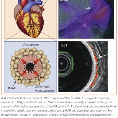 Figure 5 Involvement of Coronary Adventitial Inflammation in the Pathogenesis of Coronary Artery Spasm