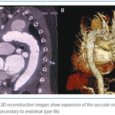 Figure 3 Repeat CT Aortogram After Thoracic Endovascular Aortic Repair