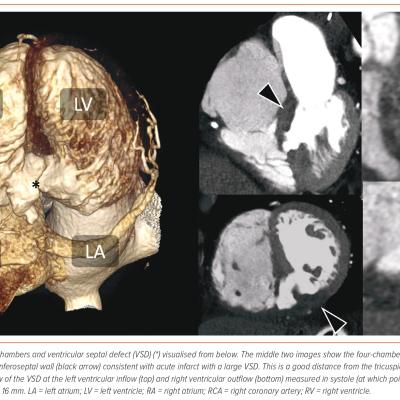 Figure 1 Cardiac CT Assessment of a Basal Inferoseptal Ventricular Septal Defect