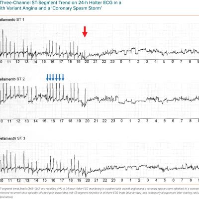 Figure 1 Three-Channel ST-Segment Trend on 24-h Holter ECG in a  Patient with Variant Angina and a ‘Coronary Spasm Storm’