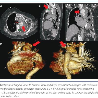 Figure 1 CT Aortogram