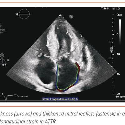 Figure 1 Echocardiography in Cardiac Amyloidosis