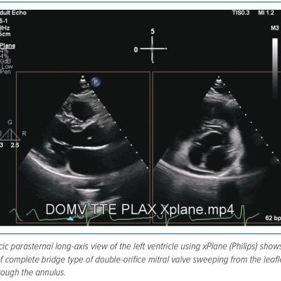 Figure 1 Double-orifice Mitral Valve