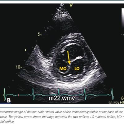 Figure 2 Double-outlet Mitral Valve Orifice