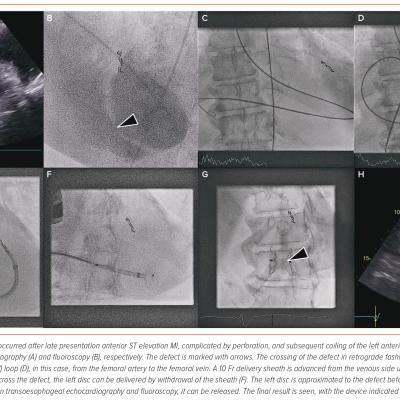 Figure 2 Percutaneous Post-infarction Ventricular Septal Defect Closure