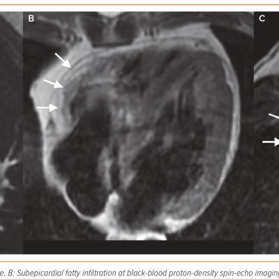 Figure 4 Cardiac Magnetic Resonance in Arrhythmogenic Cardiomyopathy Right Ventricular  Arrhythmogenic Cardiomyopathy Manifesting with Right Ventricular Free Wall Hypo/Akinesia