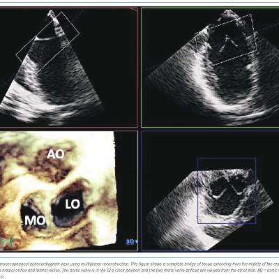 Figure 4 3D Transoesophageal View