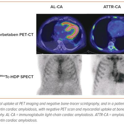 Figure 5 Nuclear Medicine in Cardiac  Amyloidosis Scans from 18F-Florbetaben PET  and from 99mTc-HDP Scintigraphy in a Patient  with Light Chain Cardiac Amyloidosis