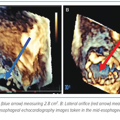 Figure 5 Transoesophageal Echocardiogram  Images 3D Multiplanar Reconstruction