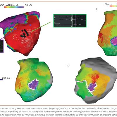 Figure 4 Substrate Ablation and Ventricular Tachycardia Activation Mapping of Left Ventricular Lateral Epicardial Ventricular Tachycardia