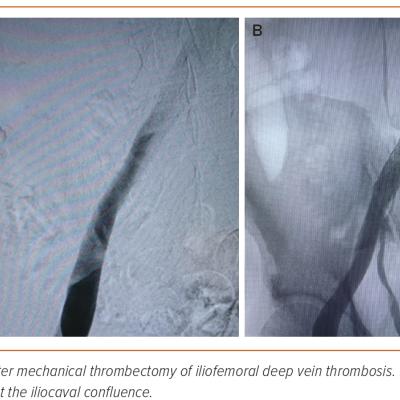 Figure 3 Abre Placement Following Thrombectomy of Acute Iliofemoral Deep Venous Thrombosis