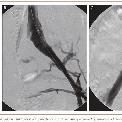 Figure 4 Zilver Vena Placement for Post-thrombotic Syndrome Stenosis